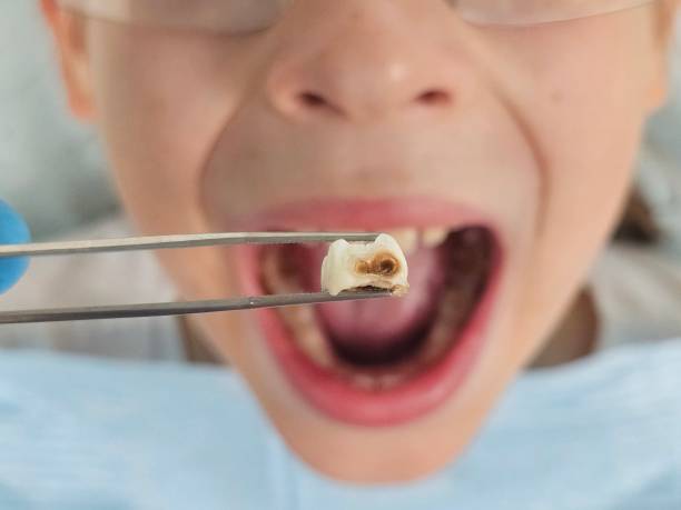 Best Cracked Tooth Emergency Dentist  in Rossmoyne, OH